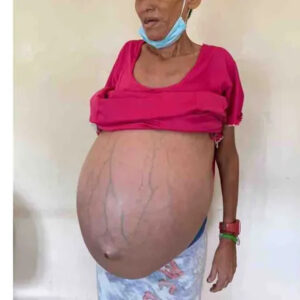 Insólito: Grave paciente en el Hospital Universitario de Maracaibo con tumor gigante y la GN decomiso los insumos de su operación