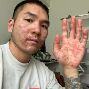 Asombroso: La «dolorosa y aterradora» experiencia de un californiano diagnosticado con viruela del simio