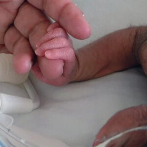 Extraño suceso: En México se registró el nacimiento de una bebé con cola de casi 6 centímetros de largo