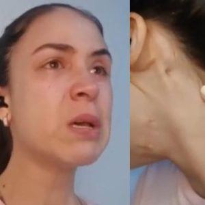 Venezolana relata cómo sobrevivió a un secuestro y un disparo en la cara en Colombia (+Video)