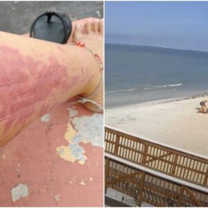 #ALERTA No menos de cinco personas muertas por bacteria come carne en playas de Florida