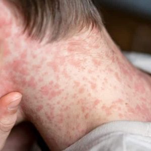 Brotes de sarampión en universidades de Florida generan preocupación por aumento de contagios