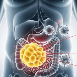 Estudios científicos vinculan obesidad y sobrepeso con mayor riesgo de 13 tipos de cáncer